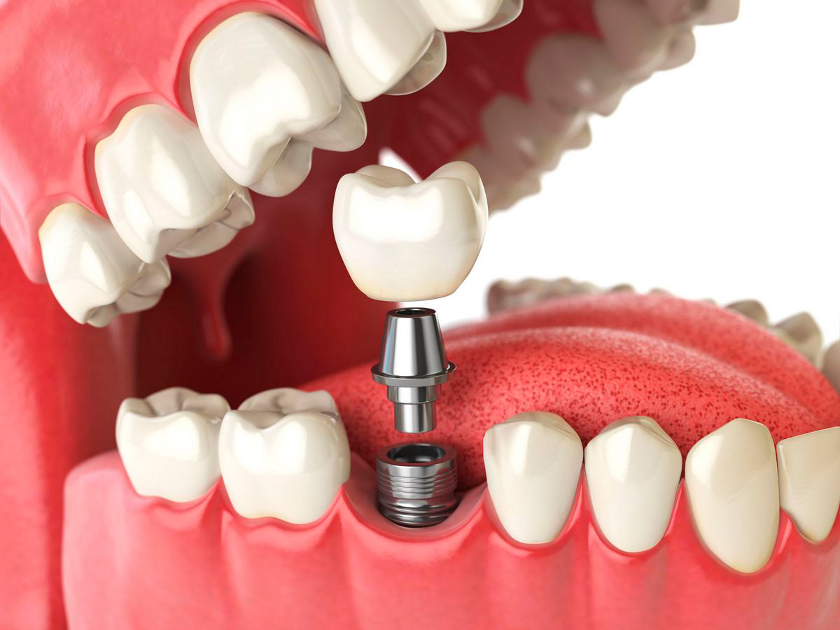Имплантаты зубов