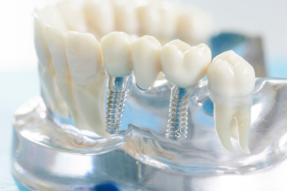 Установить зубные протезы. Мостовидный протез на 1 зуб. Несъемные зубные протезы. Мостовидынй протез на имплант.