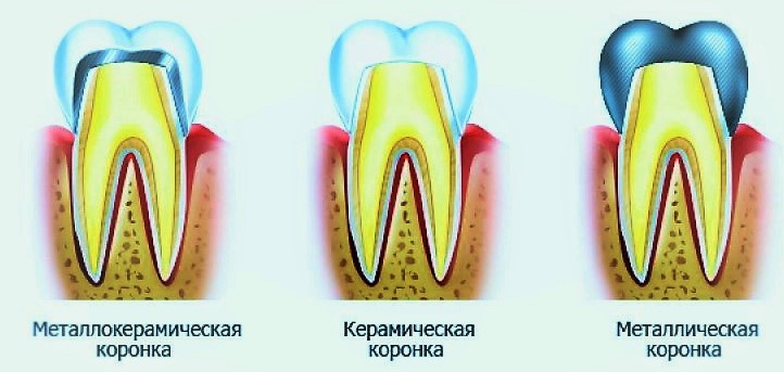 Виды зубных коронок фото