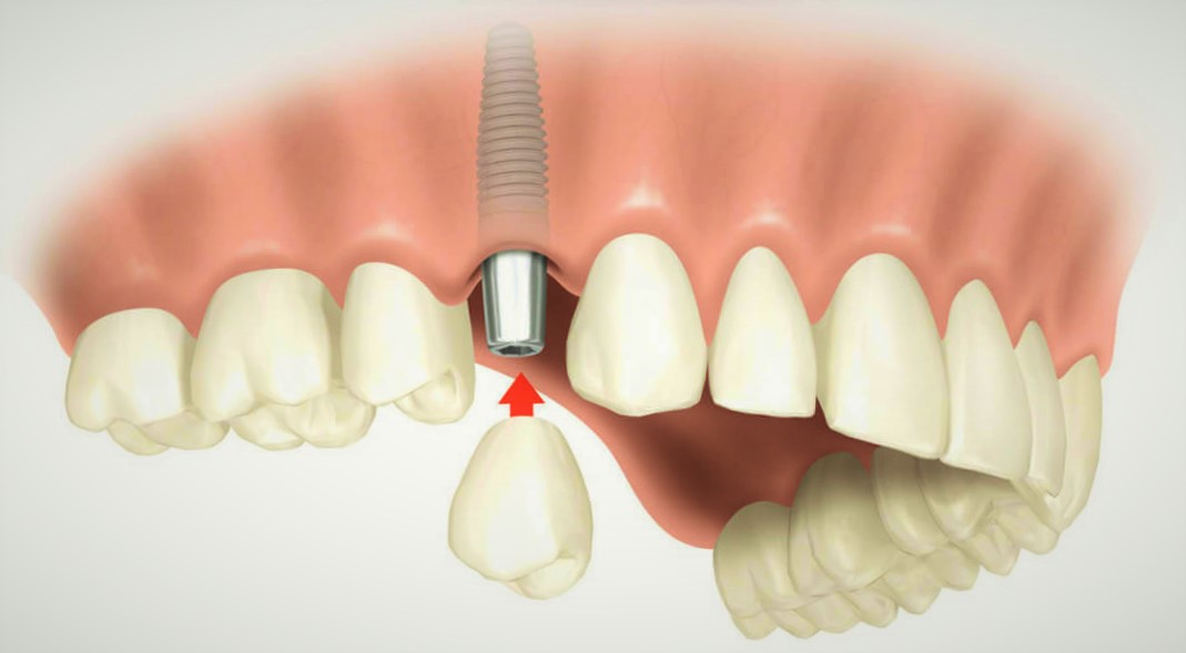 Что такое имплантация зубов фото