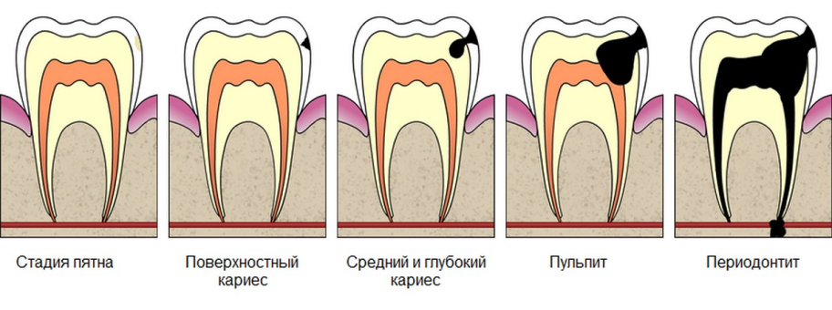 Лечение кариеса переднего зуба самара